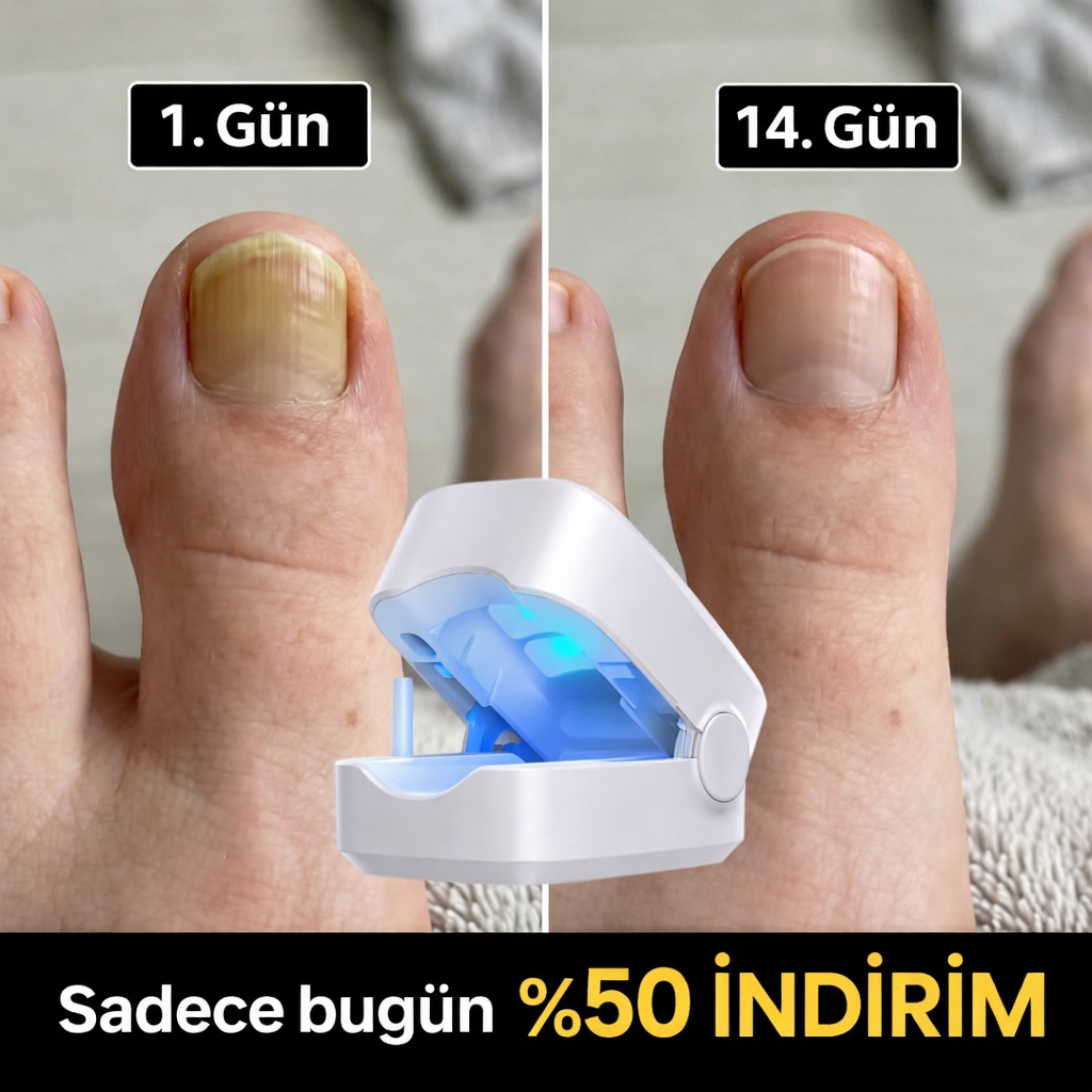 Profesyonel Tırnak Mantarı Tedavi Cihazı – Evde Kolay Kullanım